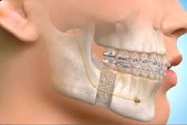 Jaw Surgery Process